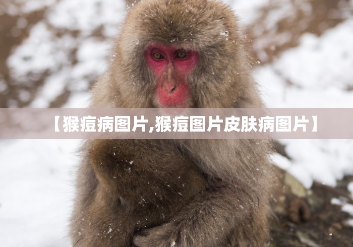 【猴痘病图片,猴痘图片皮肤病图片】